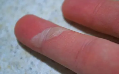 Nahaufnahme eines Fingers mit einer offenen Blase, die behandelt werden muss. Die Haut ist gerötet und die Blase ist aufgeplatzt.