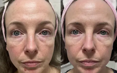 Confronto viso: pelle con niacinamide prima e dopo. Miglioramento di rossori e texture.