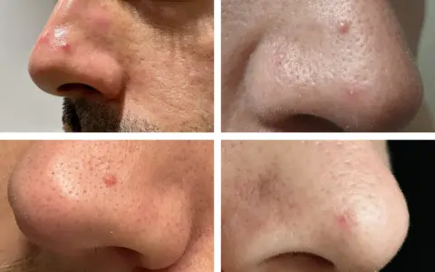 Gros plan sur le nez d'une personne, montrant des rougeurs et des petites lésions cutanées, possiblement un kyste sur le visage, nécessitant une attention médicale pour écarter tout risque de cancer.