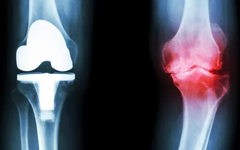 Röntgenbilder av knän: ett med protes, ett med inflammation. Ger rekommendationer efter kortisoninjektion.