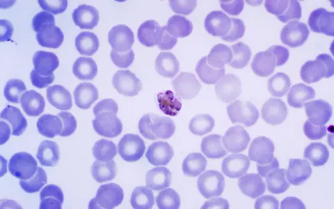 Microscopic view of red blood cells with a malaria parasite.