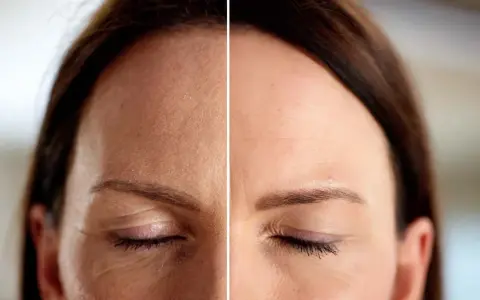 Comparación de la piel: antes y después, mostrando la reducción de arrugas de expresión alrededor de los ojos y en la frente.