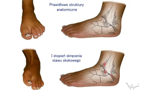 Porównanie prawidłowej anatomii stawu skokowego z I stopniem skręcenia. Widoczne uszkodzenia więzadeł.