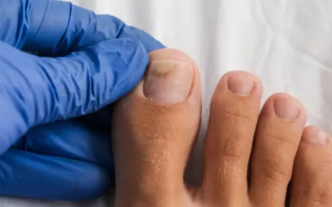 Main d'un podologue examinant un ongle de pied atteint de mycose. Renseignez-vous sur le tarif podologue mycose pour un traitement.