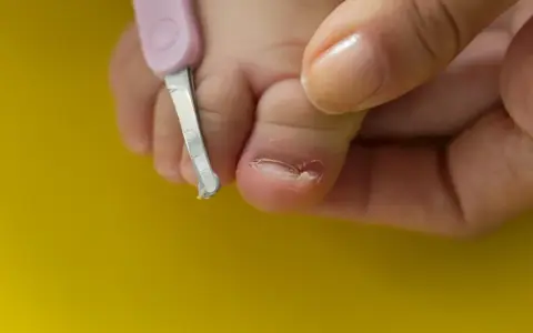 Wrastający paznokieć: Jak usunąć? Domowe i profesjonalne metody