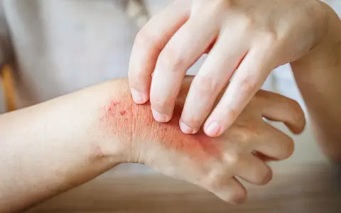 Juckende Haut: Ein Ekzem an der Hand, das durch Kratzen verschlimmert wird.