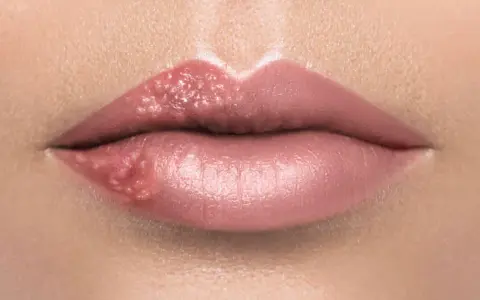 Dentysta z opryszczką? STOP! Kiedy wizyta jest bezpieczna?