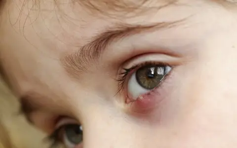 Occhio di bambino con un orzaiolo, segno di stress o stanchezza.
