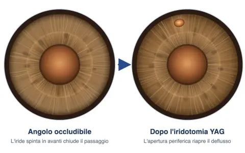 Iridotomia YAG: prima occlusione dell'angolo, dopo apertura per riaprire il deflusso. Valutare i rischi.