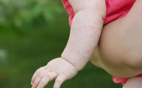 Różowe kropki na rączce dziecka mogą być jednym z objawów odry.
