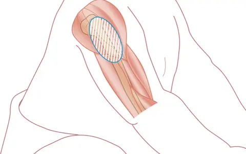 Illustration av en arm med markerad muskel där det kan kännas ont i armen efter tbe vaccination.