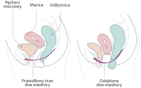 Ilustracja pokazuje różnicę między prawidłowym a osłabionym dnem miednicy, co może wpływać na wypadanie macicy. Domowe sposoby mogą pomóc wzmocnić mięśnie.
