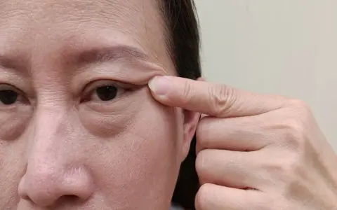 Un doigt tire la peau sous l'œil, révélant les poches sous les yeux et les rides.
