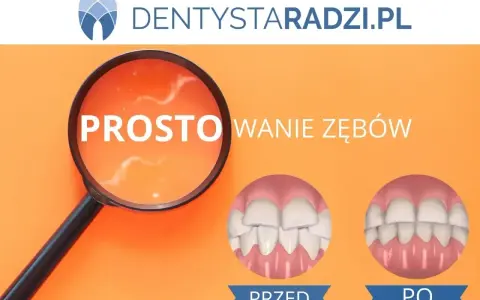 Proste licówki na krzywe zęby. Porównanie uśmiechu przed i po zabiegu.