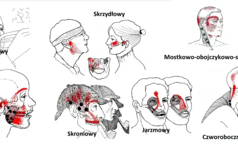 Punkty spustowe bólu w obrębie głowy i szyi, w tym mięsień skrzydłowy.