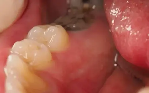 Jak długo wytrzymuje ząb leczony kanałowo? Fakty, które musisz znać