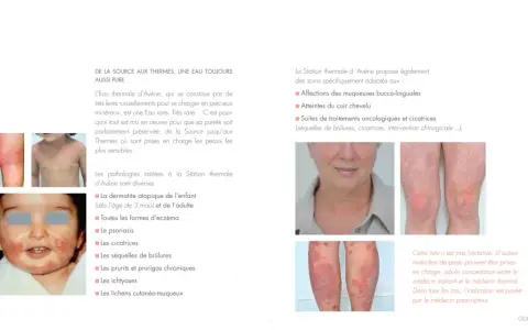La Station thermale d'Avène traite diverses pathologies cutanées, comme l'eczéma et le psoriasis, illustrées par des photos.