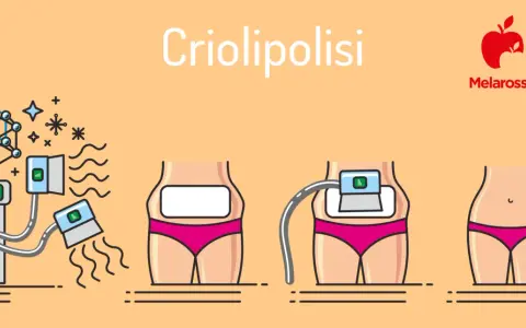 Illustrazione della criolipolisi: il processo, i benefici e i possibili criolipolisi effetti collaterali.