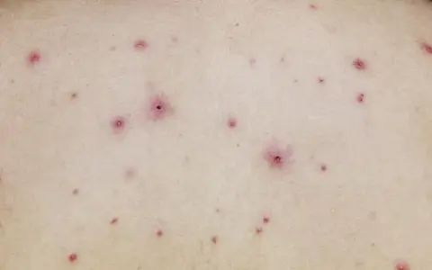 Skóra z licznymi, czerwonymi krostkami i grudkami. To mogą być ospa początki, zwiastujące chorobę.