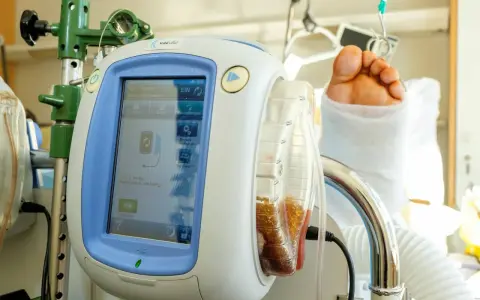 V.A.C.® Therapy Gerät mit gefülltem Behälter und einem Fuß im Verband. Die vac pumpe unterstützt die Wundheilung.