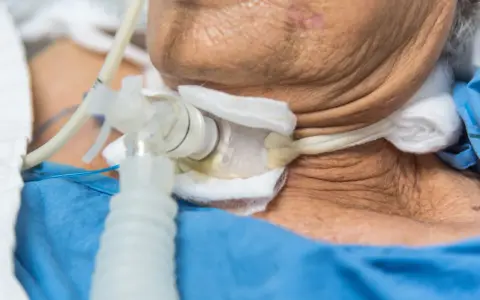 Zbliżenie na rurkę tracheostomijną u pacjenta w niebieskiej koszuli.