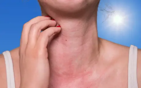 Une personne se gratte le cou rouge et irrité, peut-être à cause de boutons de soleil sur le visage et le corps. Le soleil brille intensément en arrière-plan.