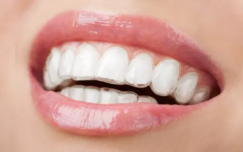 Zbliżenie na usta z błyszczącym błyszczykiem i widocznymi przezroczystymi nakładkami, które korygują zgryz. To dyskretny aparat Invisalign.