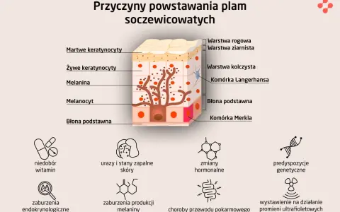 Schemat wyjaśnia, jak wyglądają plamy wątrobowe, pokazując budowę skóry i czynniki wpływające na powstawanie przebarwień.