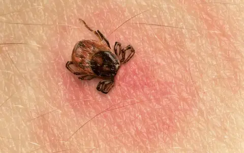 Makro zbliżenie na kleszcza przyczepionego do ludzkiej skóry. Widać jego nogi i odwłok.