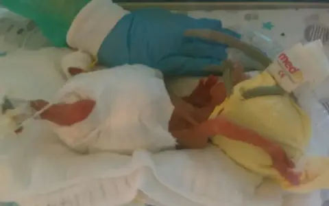 Maleńki noworodek, dziecko urodzone w 25 tygodniu ciąży, w inkubatorze, otoczony opieką medyczną.