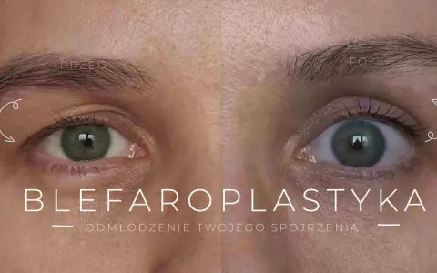 Przed i po zabiegu blefaroplastyki powiek. Odmłodzone spojrzenie, usunięcie opadających powiek.