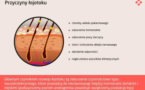 Przekrój skóry z widocznymi gruczołami łojowymi, które mogą powodować rany na skórze głowy z powodu łojotoku.