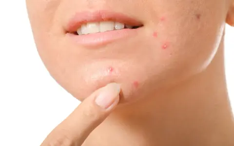 Primo piano del viso di una persona con evidenti segni di acne cistica sul mento e sulla guancia, con un dito che indica una lesione.