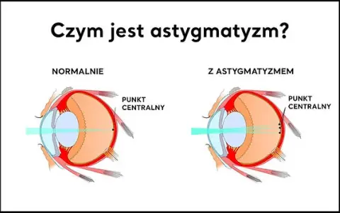 Astygmatyzm: Rozpoznaj i odzyskaj ostre widzenie!