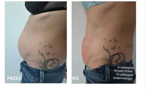 Przed i po zabiegu Accent Prime. Widoczna redukcja tkanki tłuszczowej brzucha, co pokazuje skuteczność liposukcji kawitacyjnej.