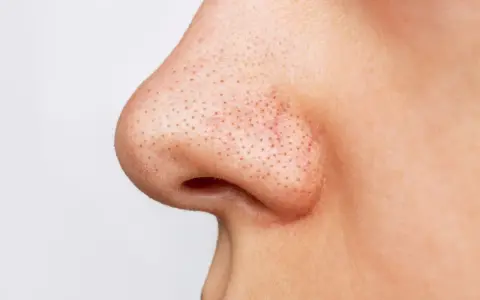 Gros plan sur un nez avec de nombreux points noirs visibles.