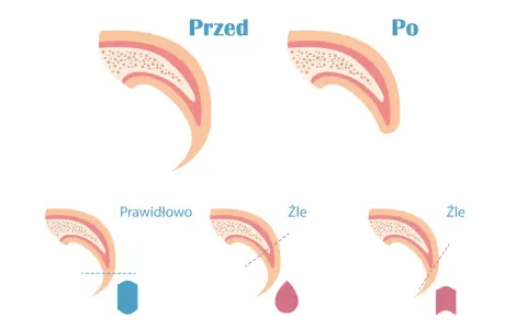 Ilustracja pokazuje przekrój pazura psa przed i po przycięciu. Pokazuje też prawidłowe i nieprawidłowe przycinanie, które może prowadzić do krwawienia.
