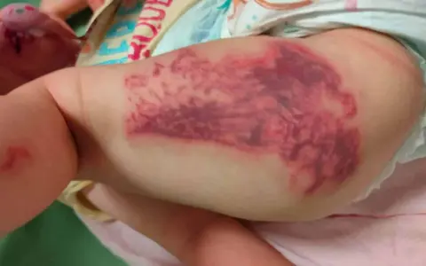 Grossa macchia violacea sulla coscia di un neonato, simile a punture di medusa (quallenstich punkte).