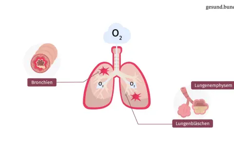 Darstellung der Lunge mit entzündeten Bronchien und zerstörten Lungenbläschen, typisch für COPD bei Rauchern.