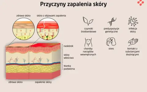 Ilustracja porównująca zdrową skórę i skórę z zapaleniem, z ikonami przedstawiającymi przyczyny AZS.