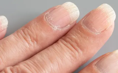 Gros plan sur des doigts montrant des ongles striés verticalement. La signification de ces ongles striés peut varier.