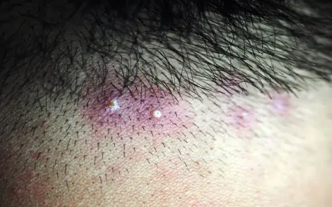 Widoczne krosty na głowie, zaczerwieniona skóra i włosy.