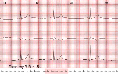 EKG z zapisem rytmu zatokowego. Widoczne są fale serca z zaznaczonymi odstępami R-R >1.5s, wskazującymi na bradykardię.