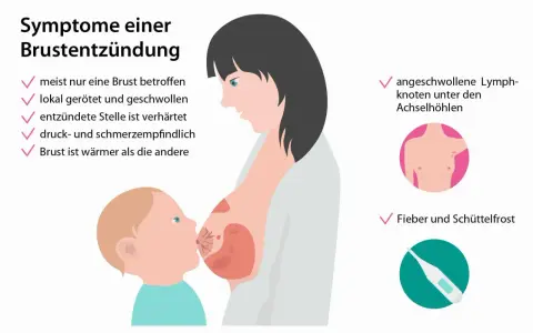 Brustentzündung: Rötung, Schwellung, Verhärtung, Schmerz, Wärme, Lymphknotenschwellung, Fieber. Dies sind häufige milchstau symptome.