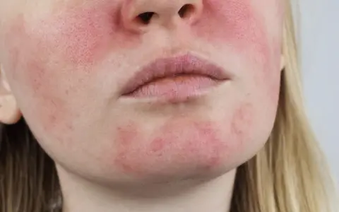 Schuppige & gerötete Haut: Ist es Rosacea? Ursachen & Lösungen