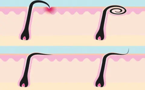 Ilustración de pelos enquistados en la piel, mostrando diferentes etapas de crecimiento y posible irritación.