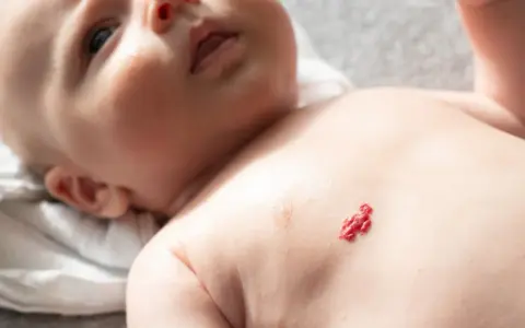 Czerwony naczyniak u noworodka na klatce piersiowej, widoczny obok delikatnej skóry dziecka.