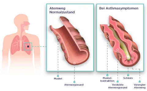 Vergleich von Atemwegen: Normalzustand vs. bei Asthmasymptomen. Bei unkontrolliertem Asthma verengen sich die Atemwege durch Muskelkontraktion und Schleimbildung.