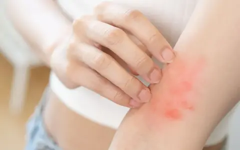Dłoń dotyka zaczerwienionej skóry na przedramieniu, objaw chorób autoimmunologicznych skóry.