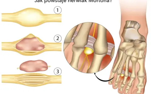 Ilustracja pokazuje powstawanie nerwiaka Mortona, który może powodować zapalenie śródstopia. Objawy to ucisk na nerw.